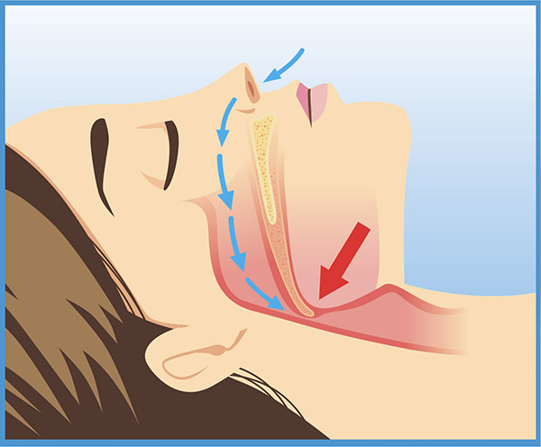 Obstructed Sleep Apnea Air Flow | Sleep Apnea Treatment | Dr. Vandervelden | Zeeland, MI